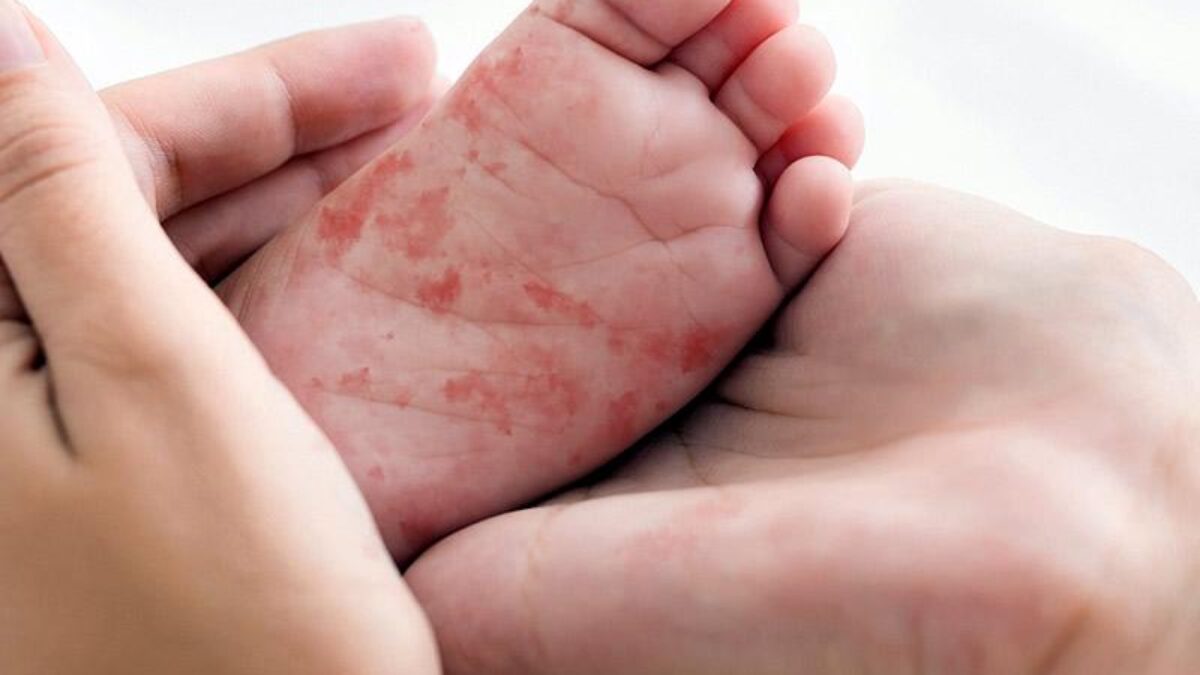 вакцина от кпк